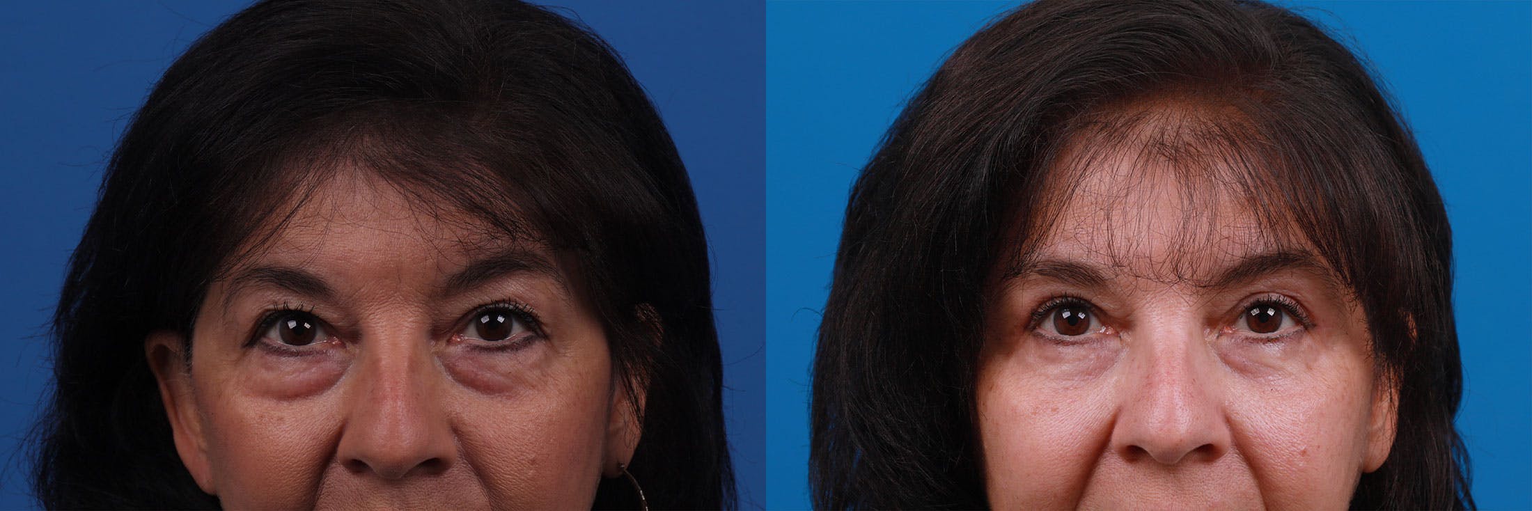 Eyelid Surgery Before & After Gallery - Patient 159002427 - Image 1
