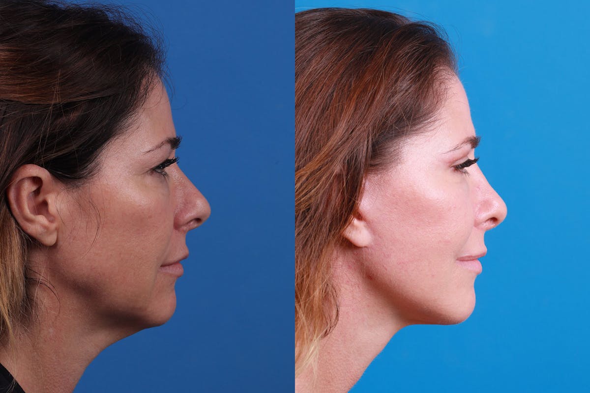 Rhinoplasty Before & After Gallery - Patient 159002463 - Image 4