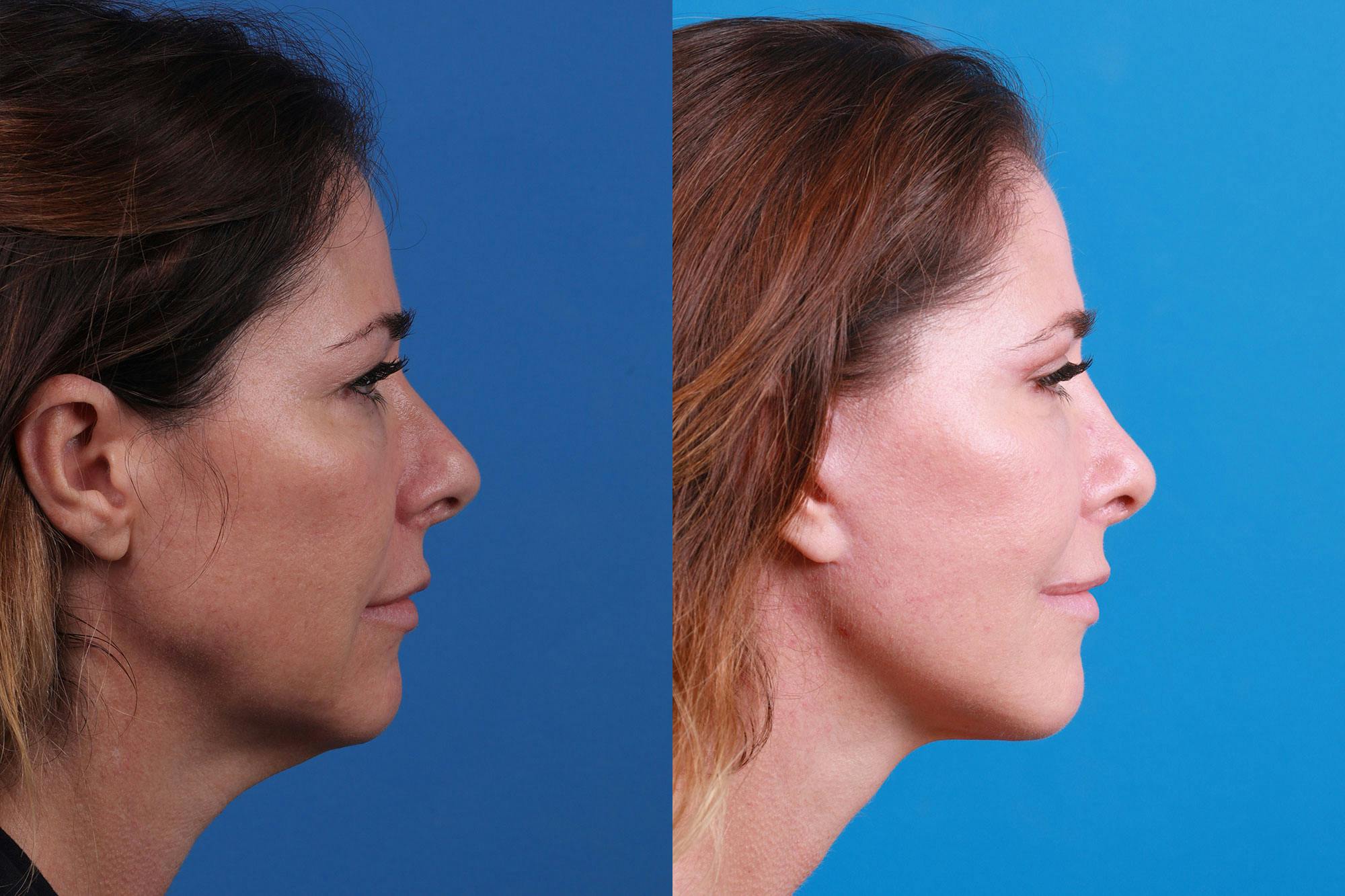 Facelift Before & After Gallery - Patient 159537382 - Image 4