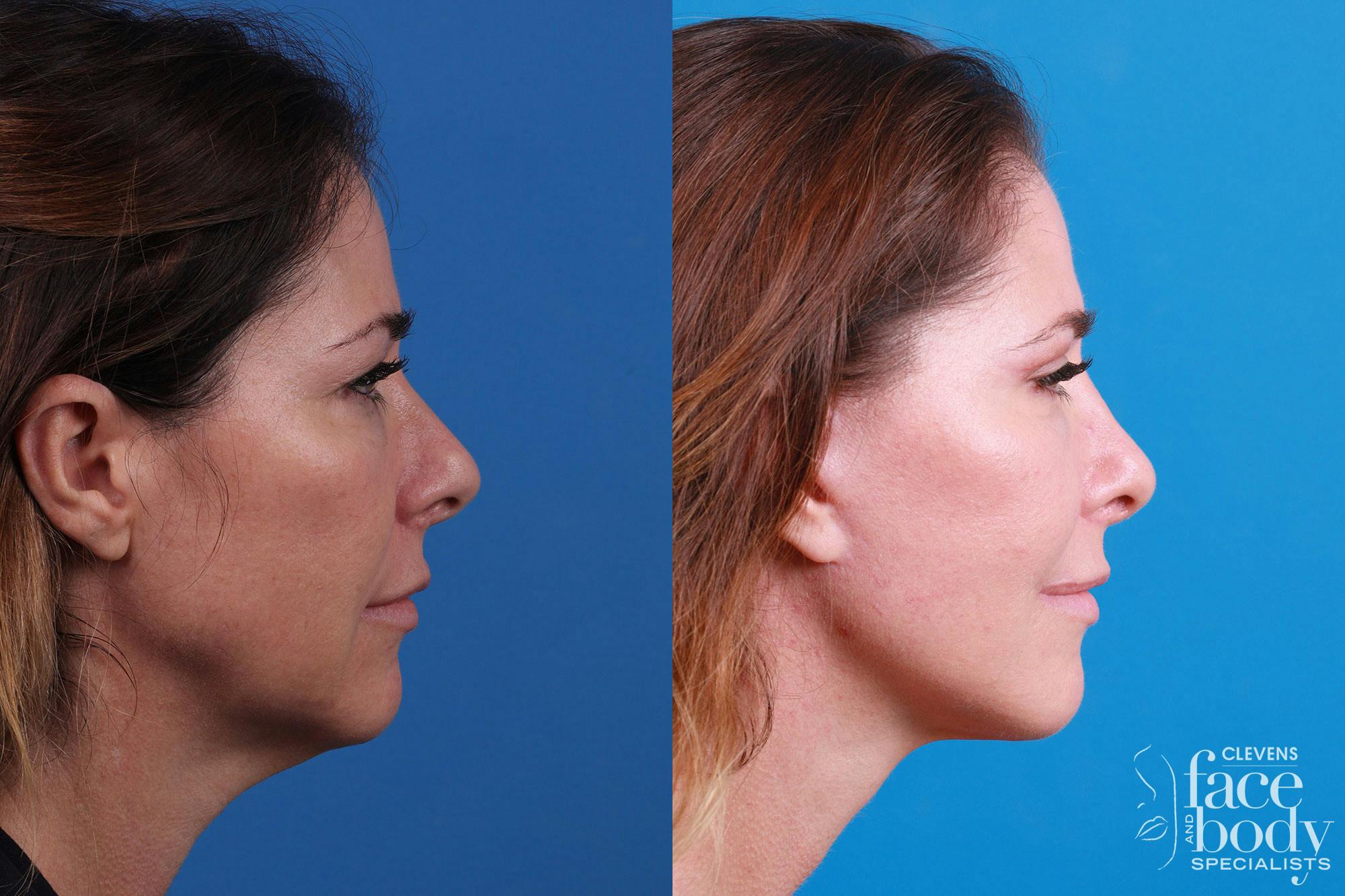 Rhinoplasty Before & After Gallery - Patient 159002463 - Image 4