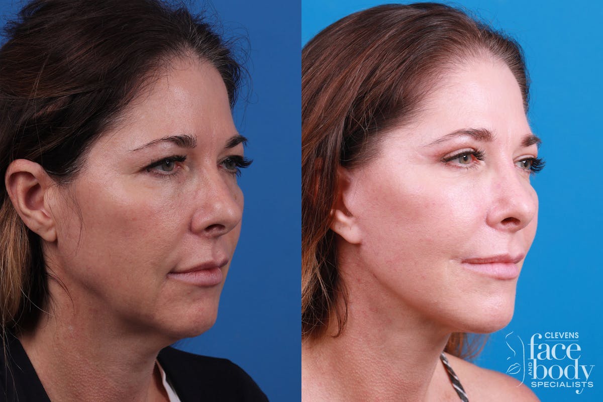 Rhinoplasty Before & After Gallery - Patient 159002463 - Image 5