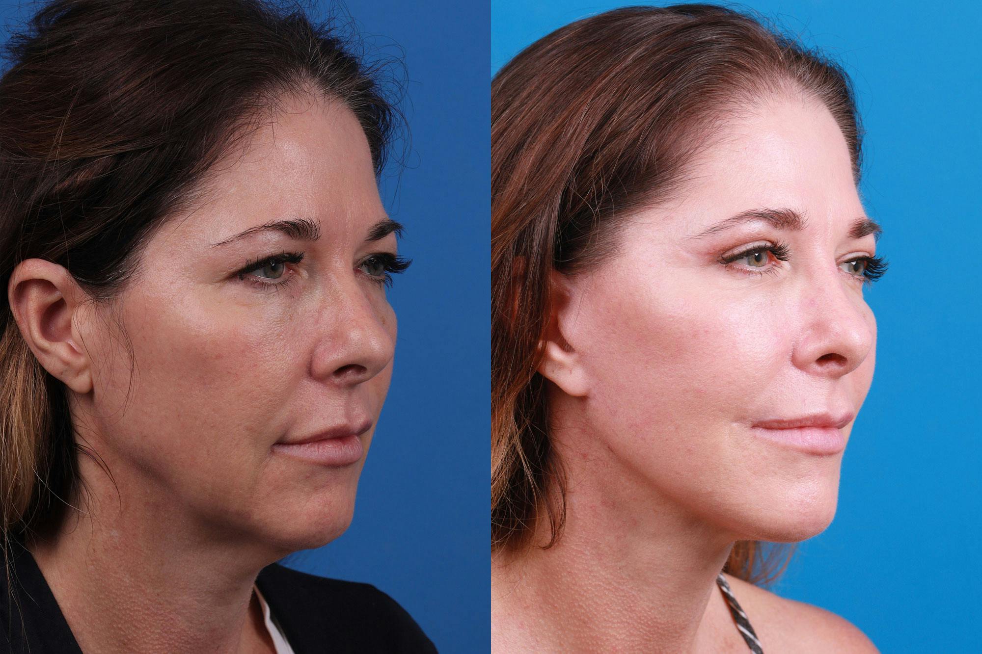 Rhinoplasty Before & After Gallery - Patient 159002463 - Image 5