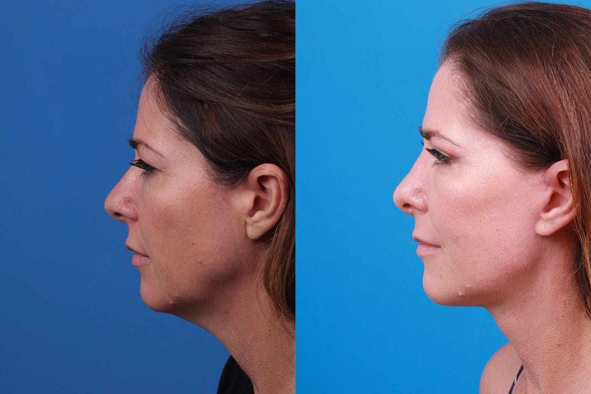 Rhinoplasty Before & After Gallery - Patient 159002463 - Image 3