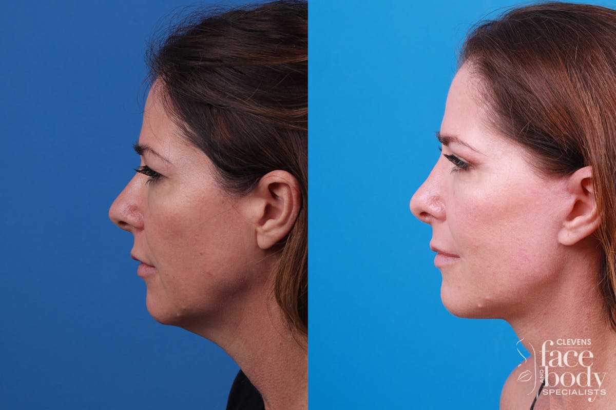 Rhinoplasty Before & After Gallery - Patient 159002463 - Image 3