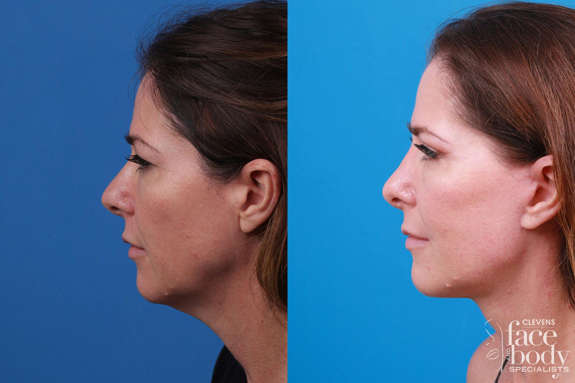 Rhinoplasty Before & After Gallery - Patient 159002463 - Image 3