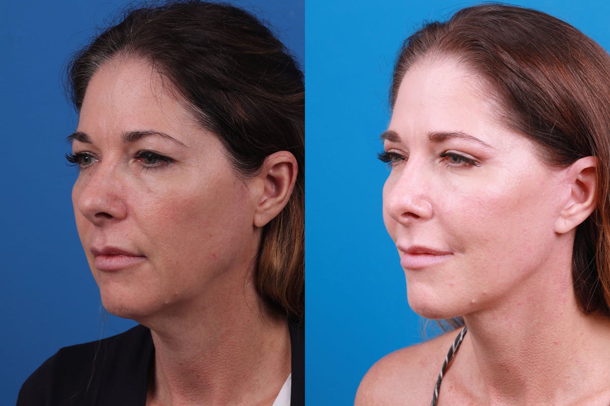Rhinoplasty Before & After Gallery - Patient 159002463 - Image 2
