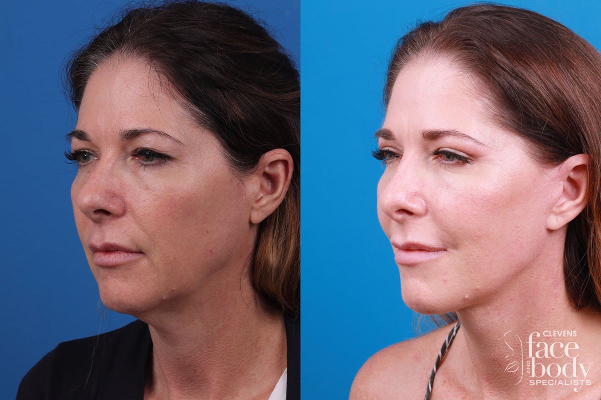 Rhinoplasty Before & After Gallery - Patient 159002463 - Image 2