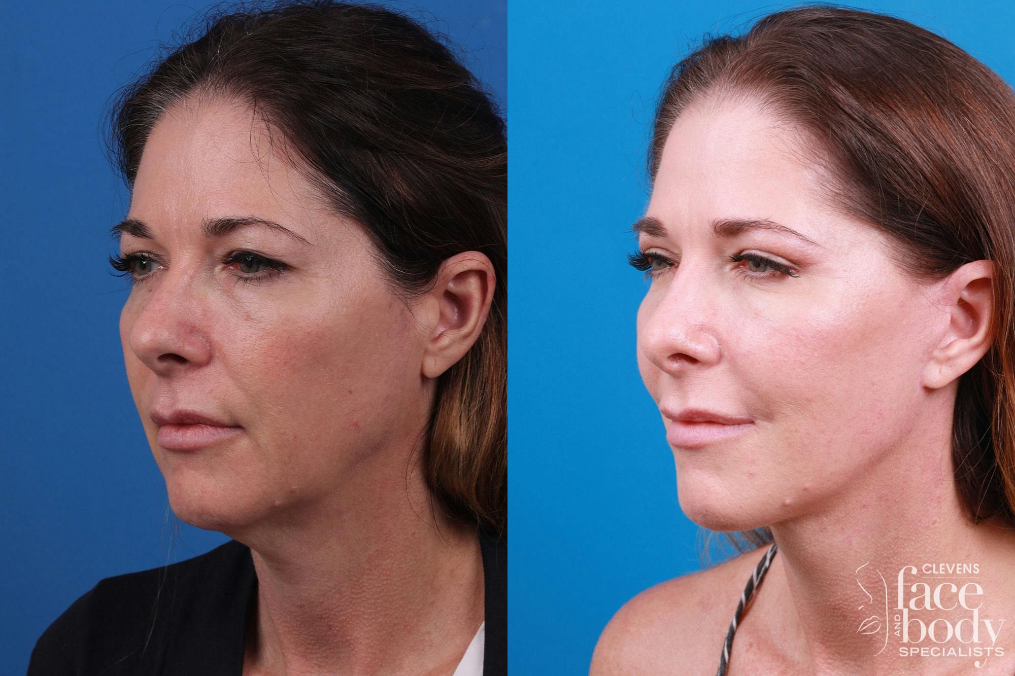 Rhinoplasty Before & After Gallery - Patient 159002463 - Image 2