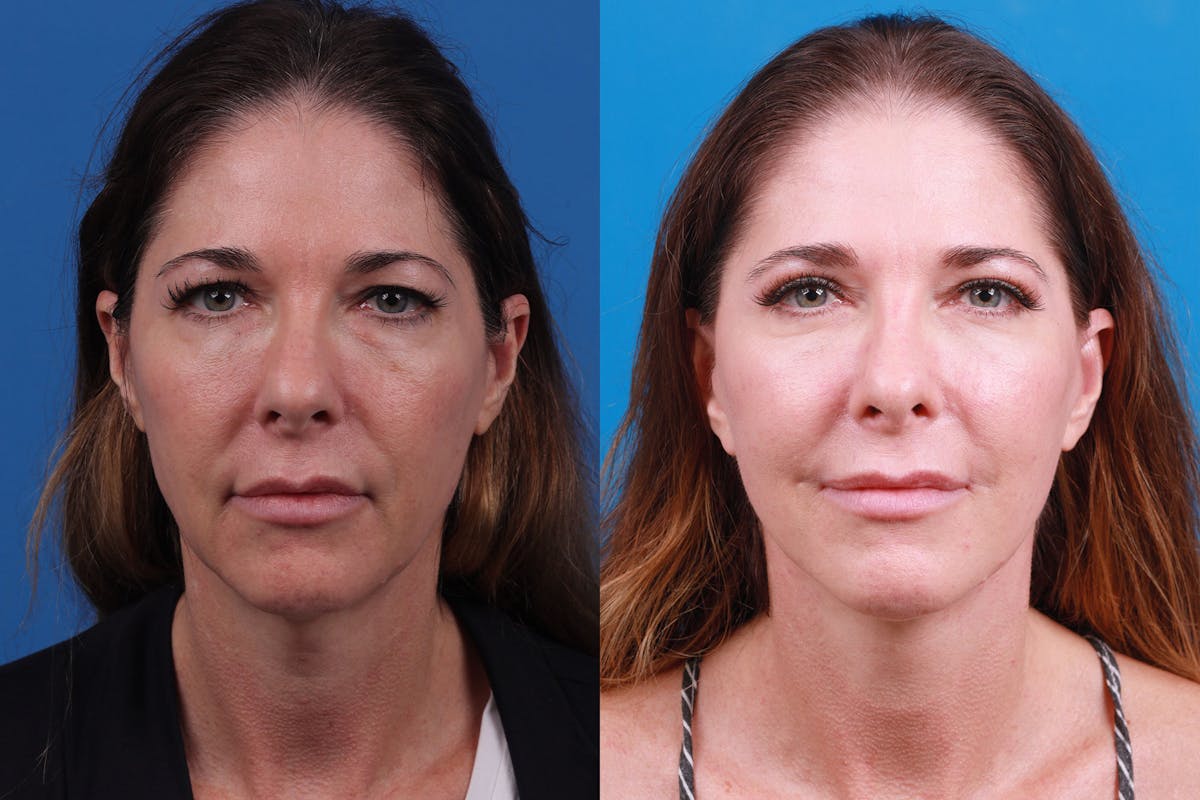 Eyelid Surgery Before & After Gallery - Patient 159002438 - Image 1
