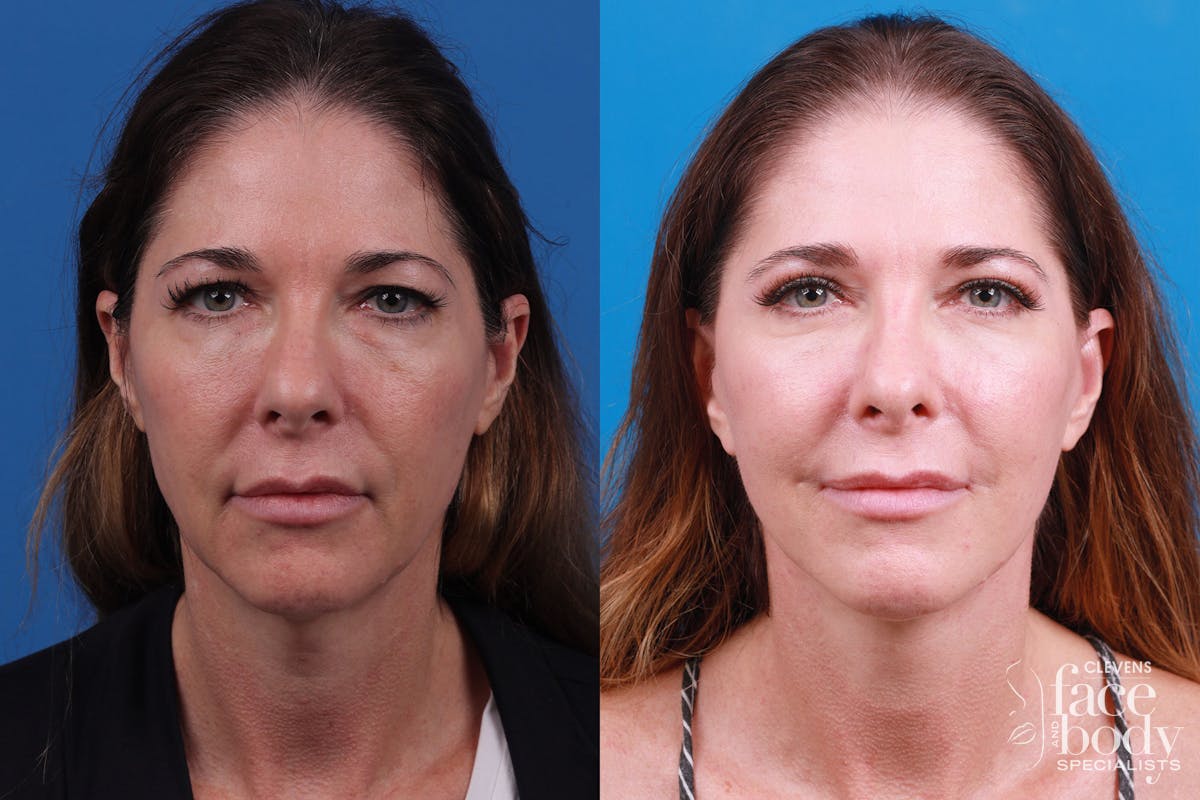 Rhinoplasty Before & After Gallery - Patient 159002463 - Image 1