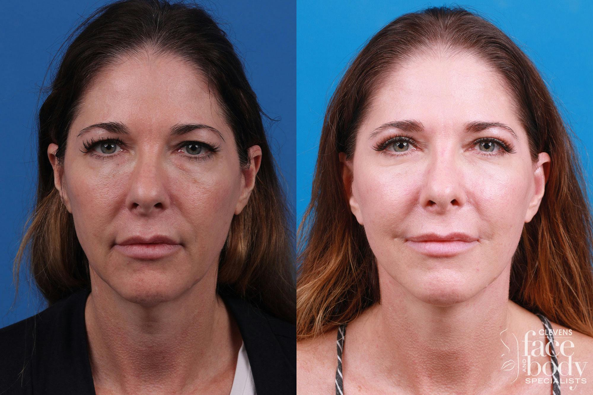 Rhinoplasty Before & After Gallery - Patient 159002463 - Image 1
