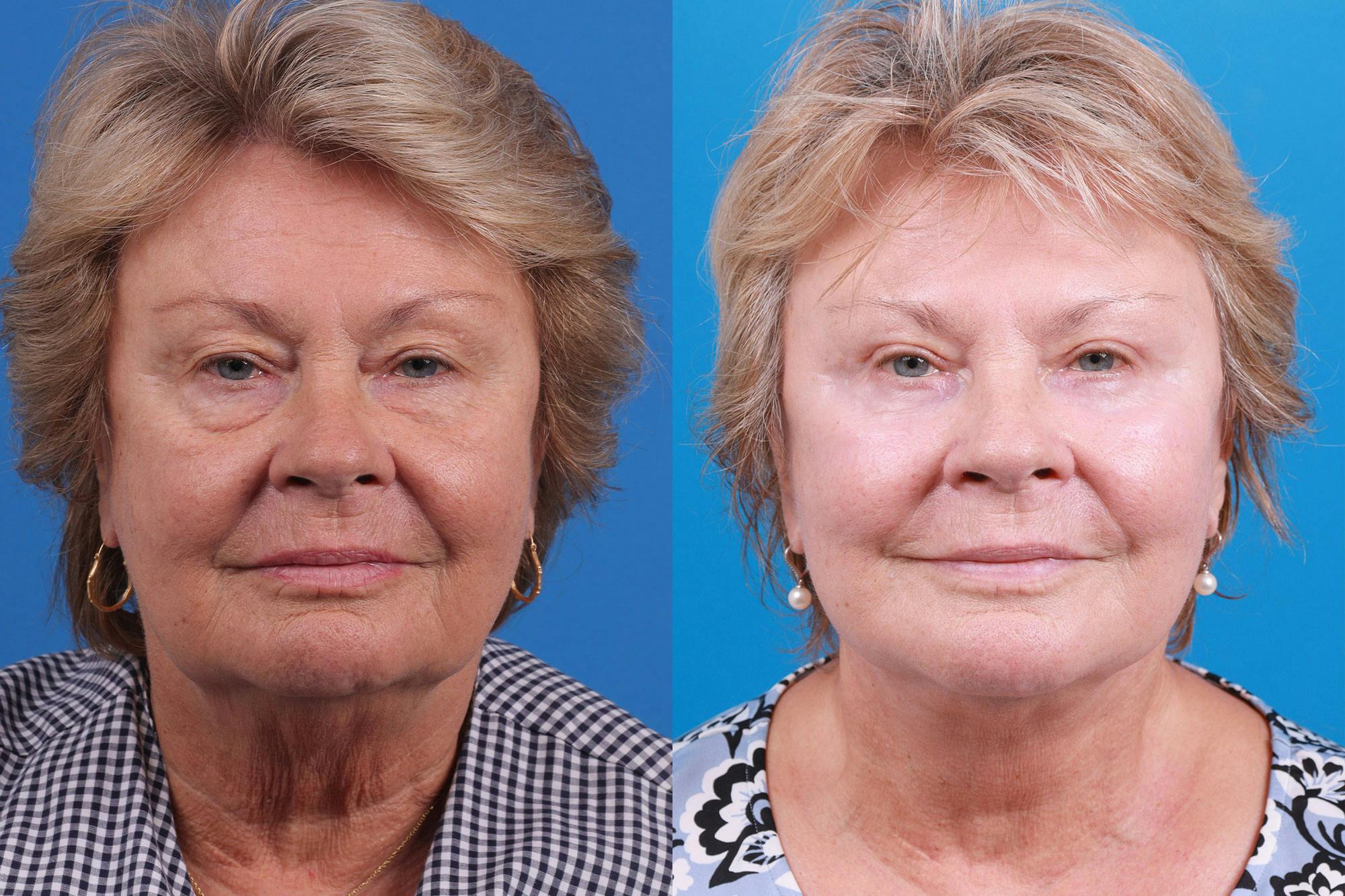 Facelift Before & After Gallery - Patient 160202833 - Image 1