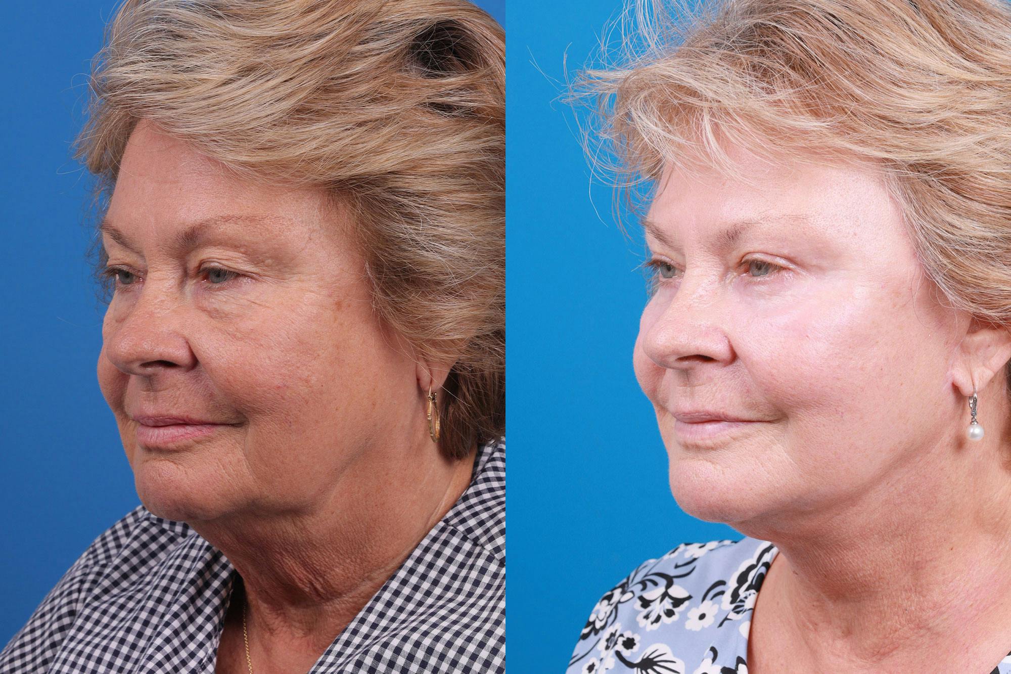 Facelift Before & After Gallery - Patient 160202833 - Image 2