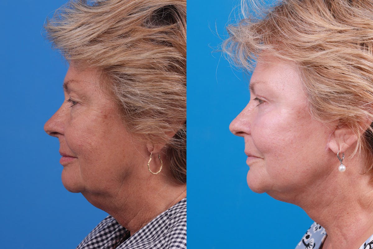 Facelift Before & After Gallery - Patient 160202833 - Image 3