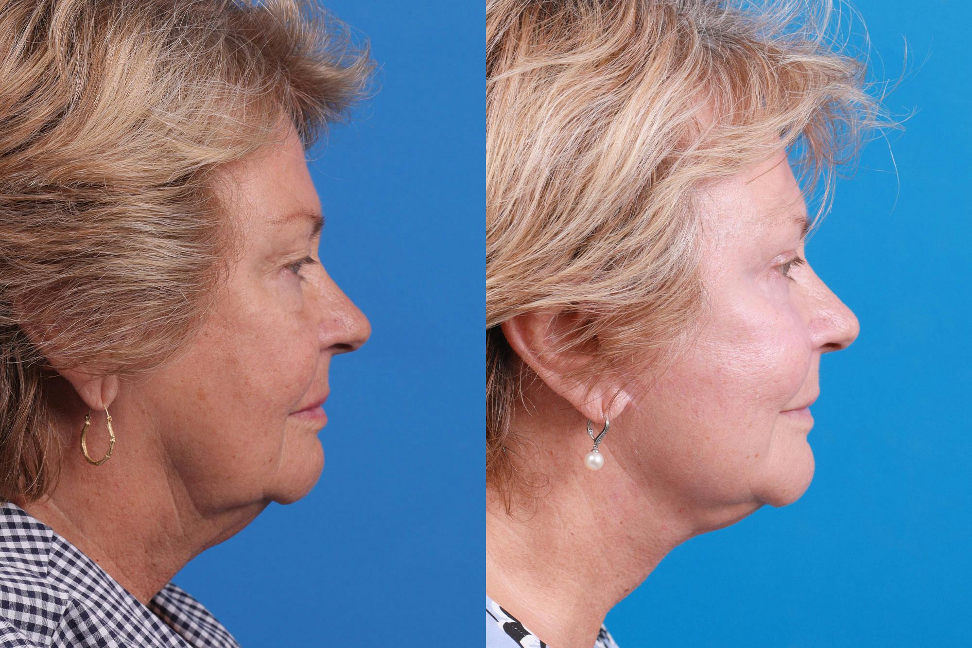 Facelift Before & After Gallery - Patient 160202833 - Image 4