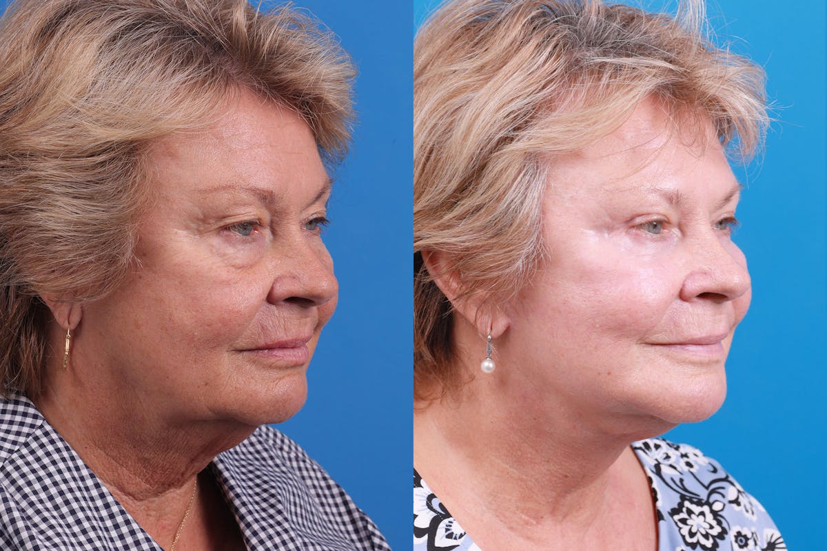 Facelift Before & After Gallery - Patient 160202833 - Image 5