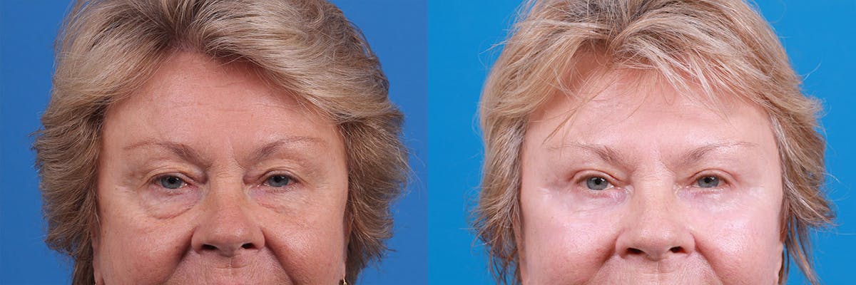 Eyelid Surgery Before & After Gallery - Patient 160202835 - Image 1