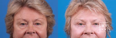Eyelid Surgery Before & After Gallery - Patient 184252 - Image 1