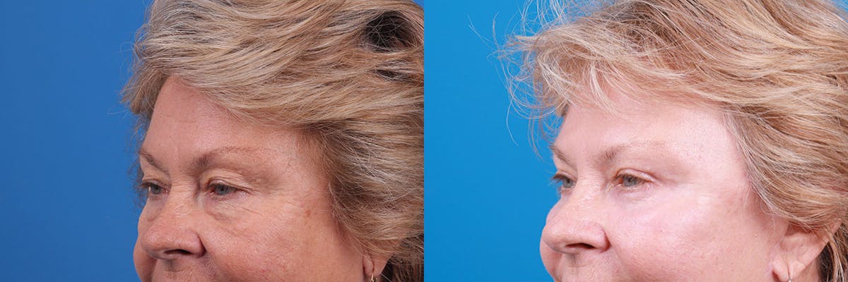 Eyelid Surgery Before & After Gallery - Patient 160202835 - Image 2