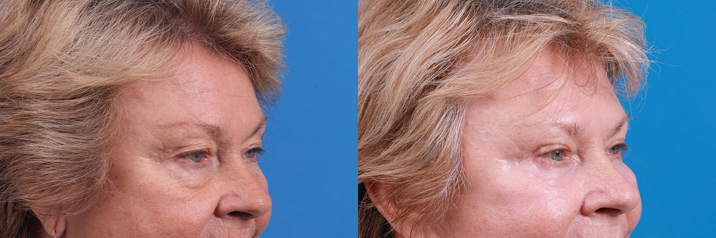 Eyelid Surgery Before & After Gallery - Patient 184252 - Image 3