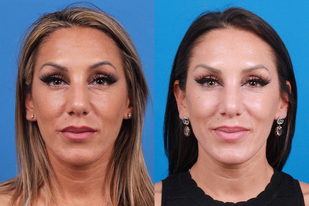 Rhinoplasty Before & After Gallery - Patient 160571918 - Image 1