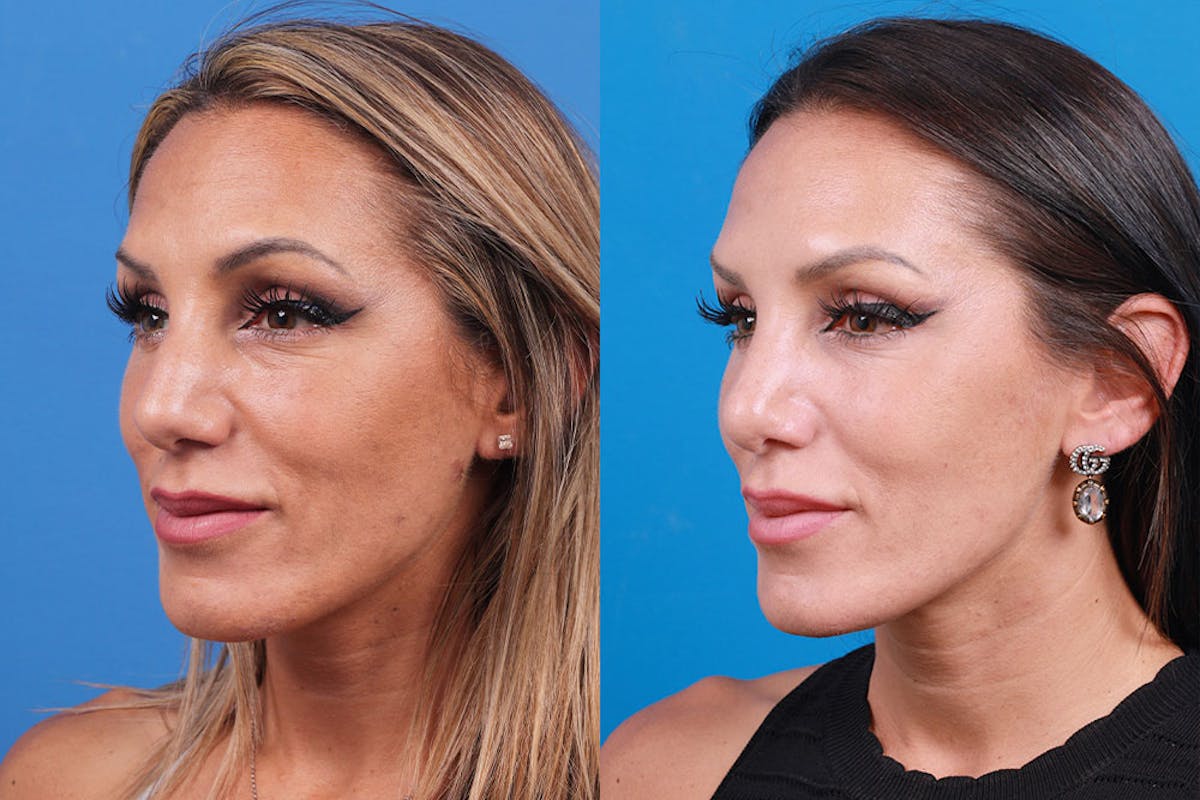 Rhinoplasty Before & After Gallery - Patient 160571918 - Image 2