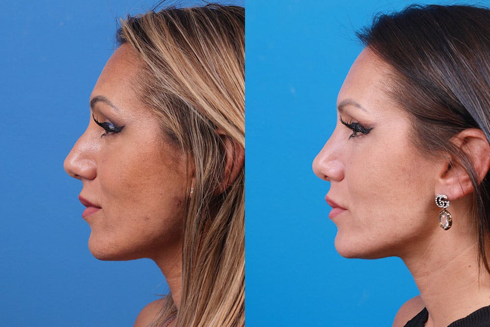 Rhinoplasty Before & After Gallery - Patient 160571918 - Image 3