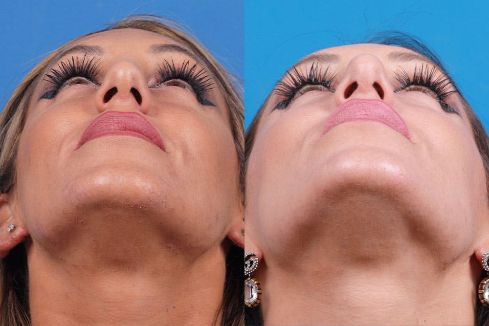 Rhinoplasty Before & After Gallery - Patient 160571918 - Image 4