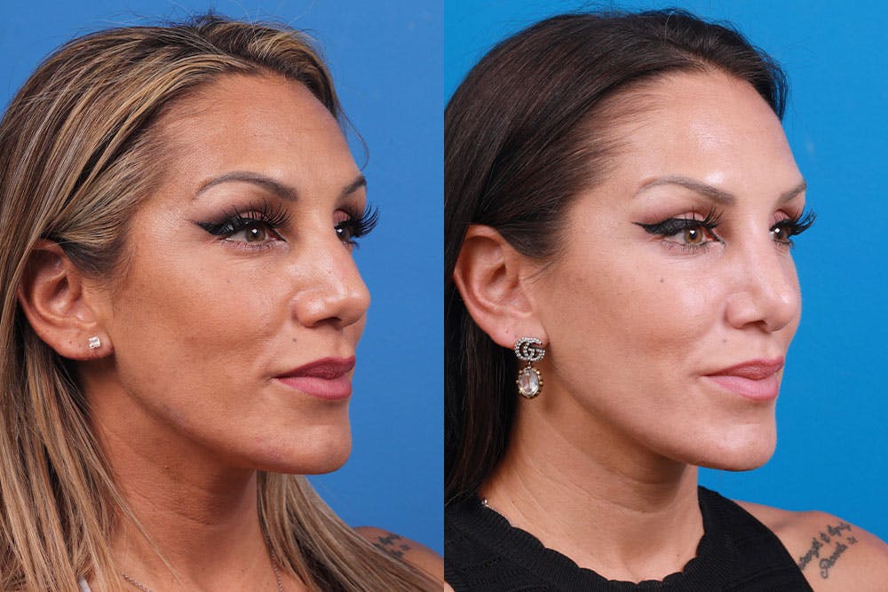 Rhinoplasty Before & After Gallery - Patient 160571918 - Image 5