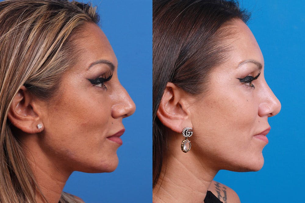 Rhinoplasty Before & After Gallery - Patient 160571918 - Image 6