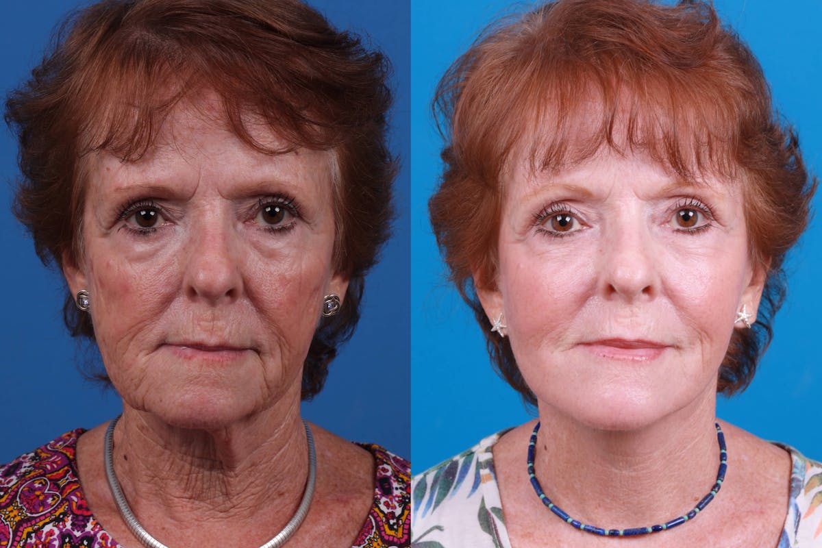 Skin Resurfacing Before & After Gallery - Patient 160941818 - Image 1