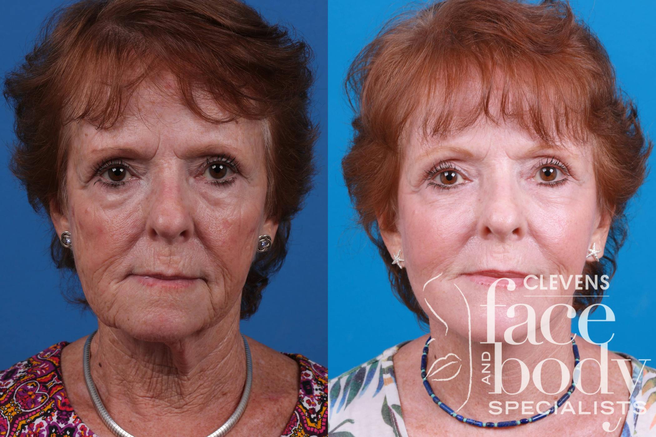 Laser Skin Resurfacing