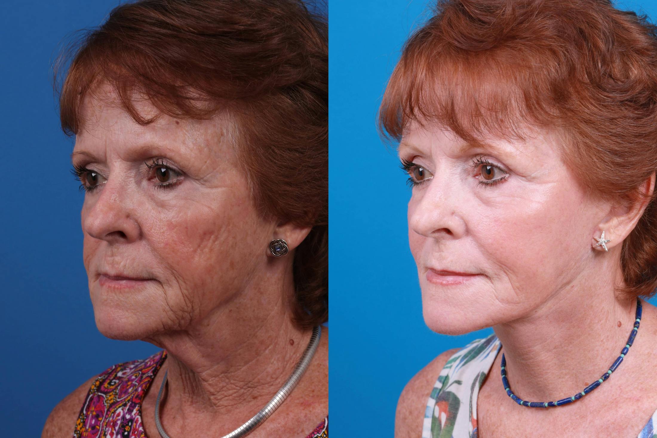 Facelift Before & After Gallery - Patient 160941815 - Image 2