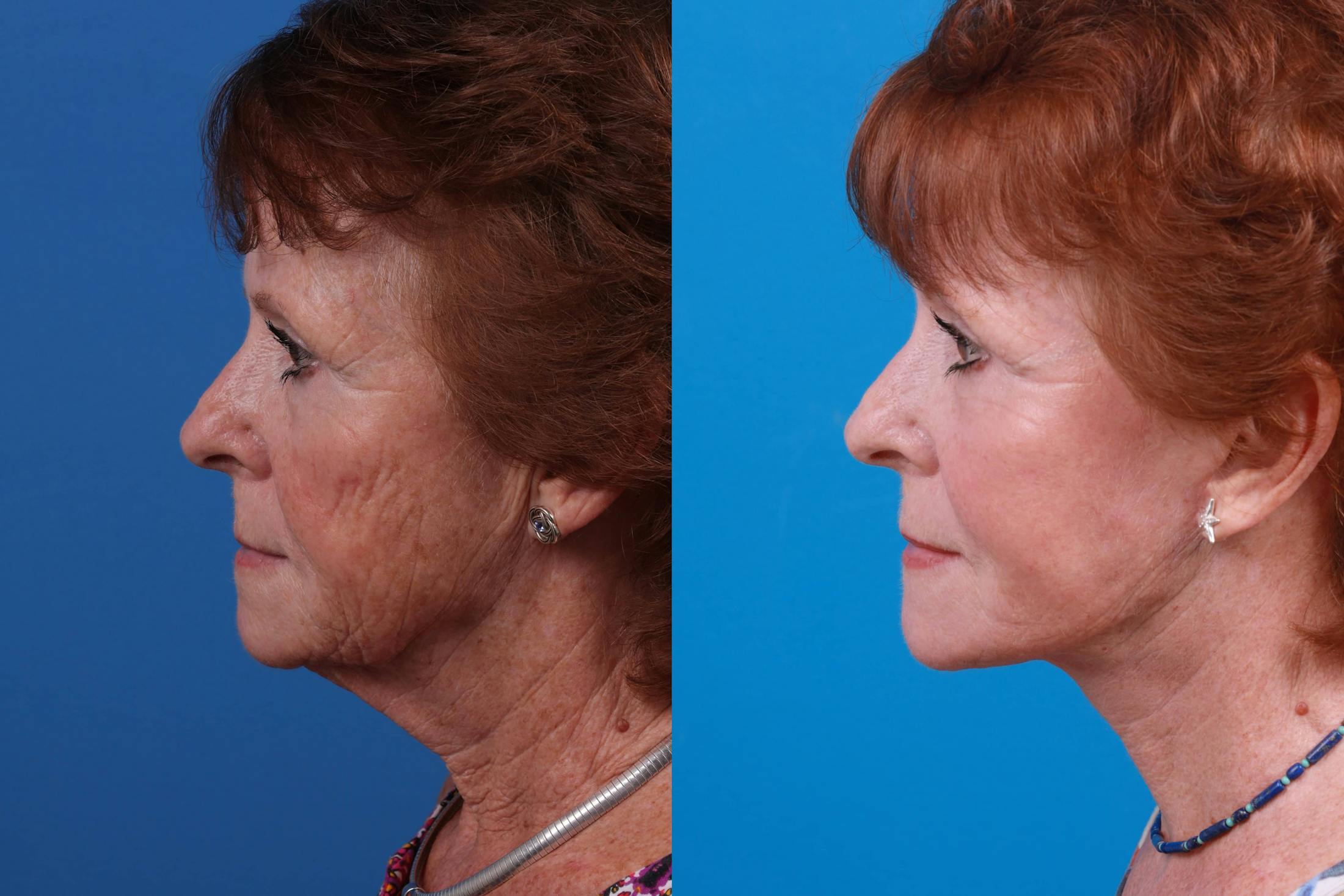 Facelift Before & After Gallery - Patient 160941815 - Image 3