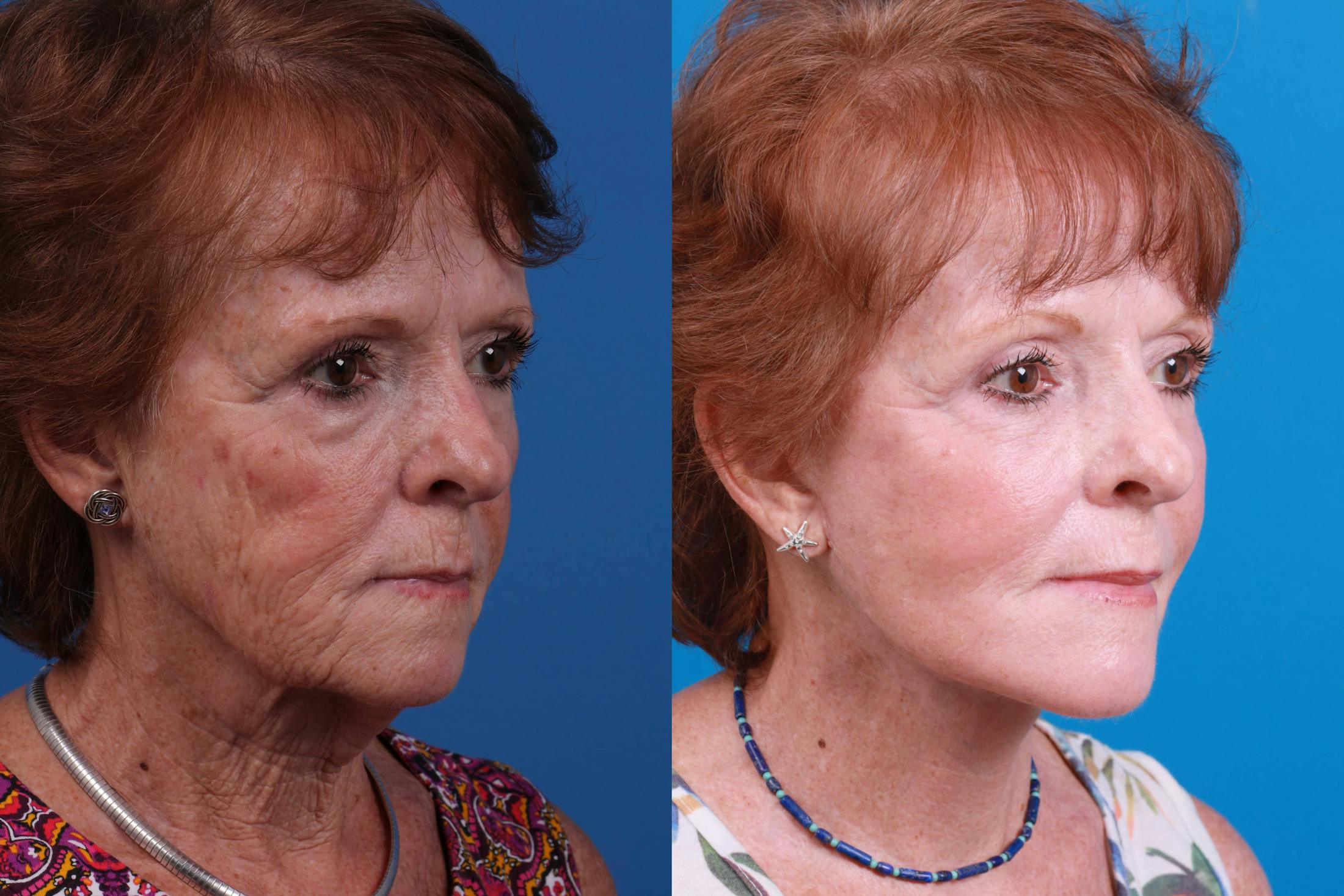 Facelift Before & After Gallery - Patient 160941815 - Image 4