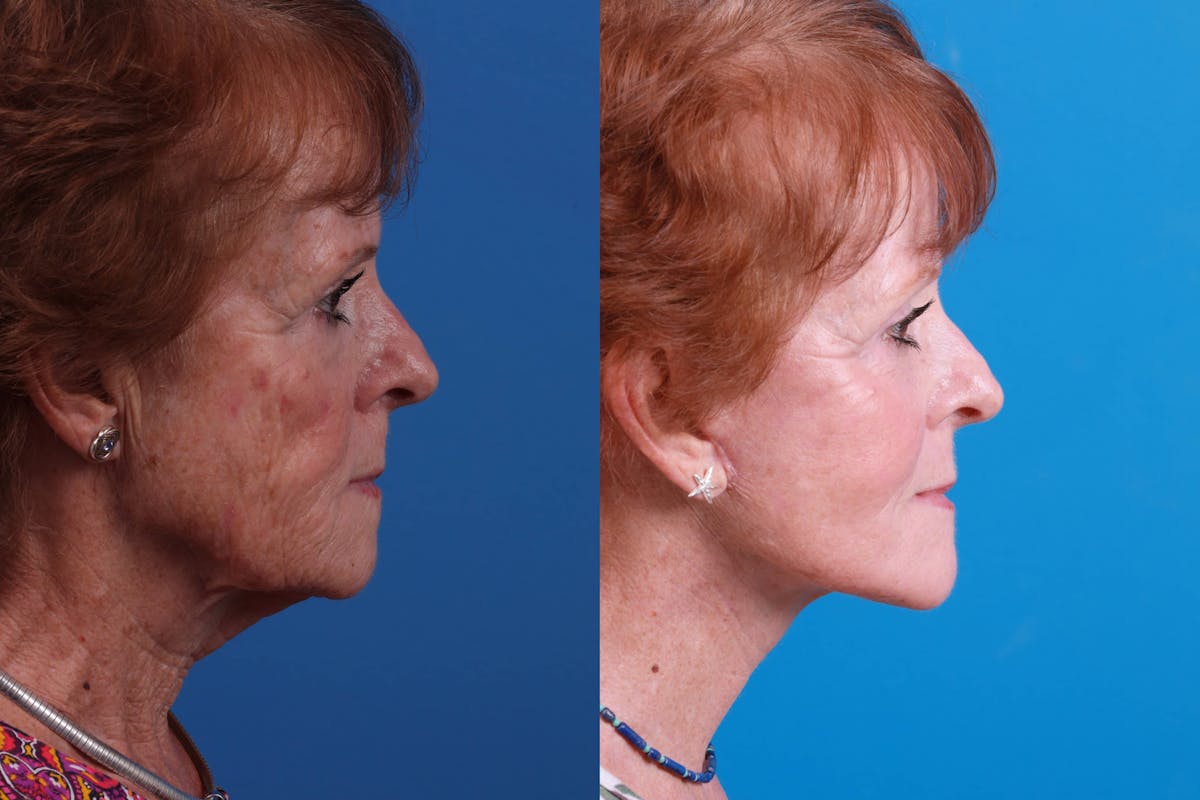 Skin Resurfacing Before & After Gallery - Patient 160941818 - Image 5
