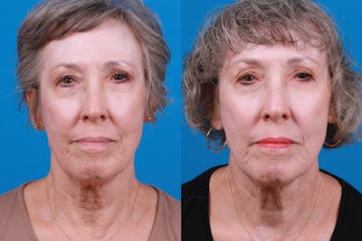 Morpheus8 Before & After Gallery - Patient 161571733 - Image 1