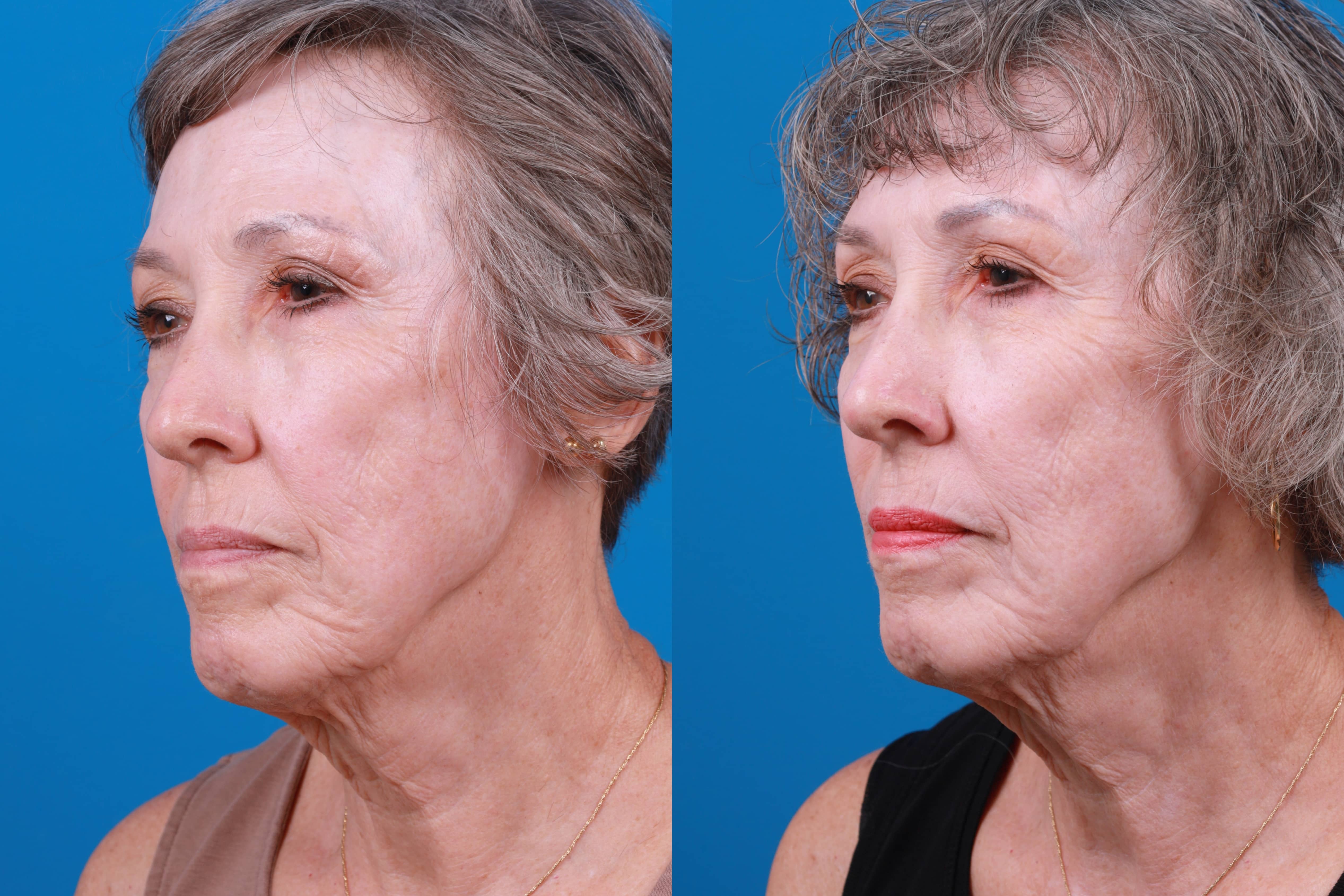 Morpheus8 Before & After Gallery - Patient 161571733 - Image 2