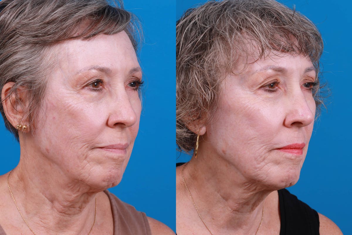 Morpheus8 Before & After Gallery - Patient 161571733 - Image 3