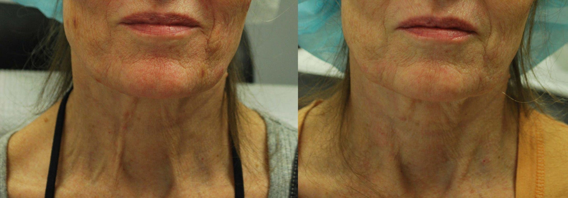 Morpheus8 Before & After Gallery - Patient 161571736 - Image 1