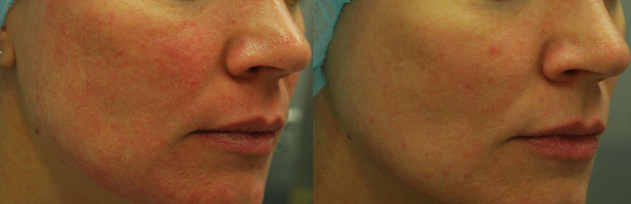 Morpheus8 Before & After Gallery - Patient 161571737 - Image 1