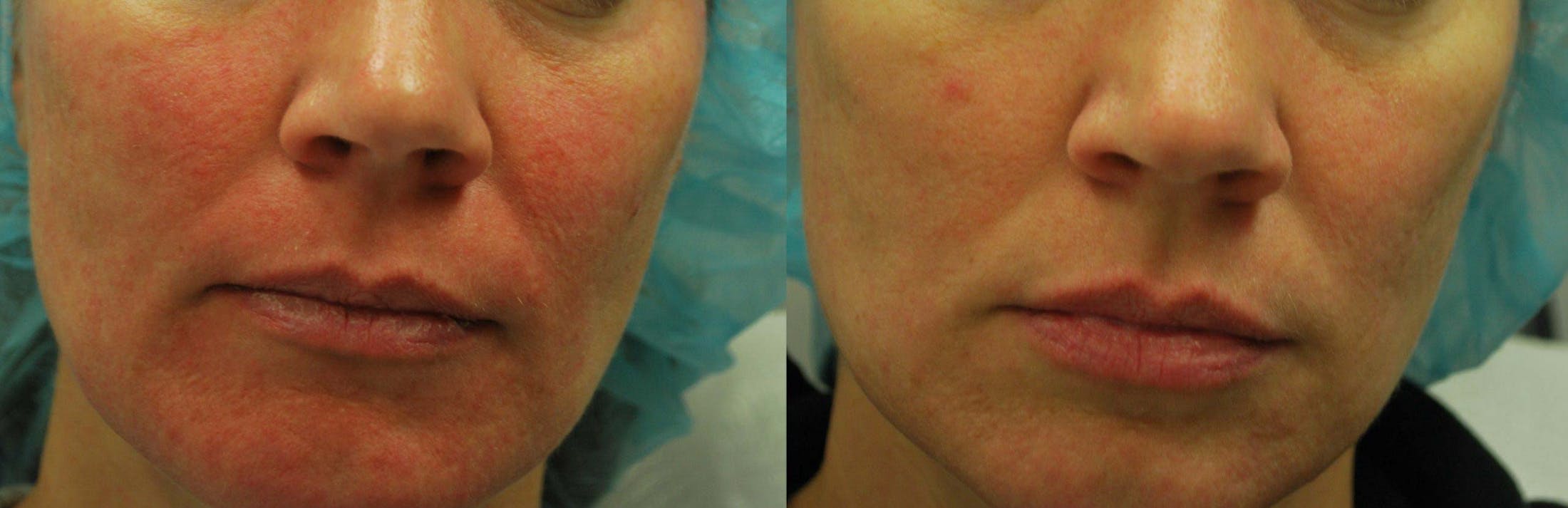 Morpheus8 Before & After Gallery - Patient 161571737 - Image 2