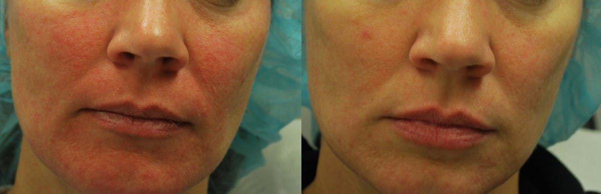 Morpheus8 Before & After Gallery - Patient 161571737 - Image 2