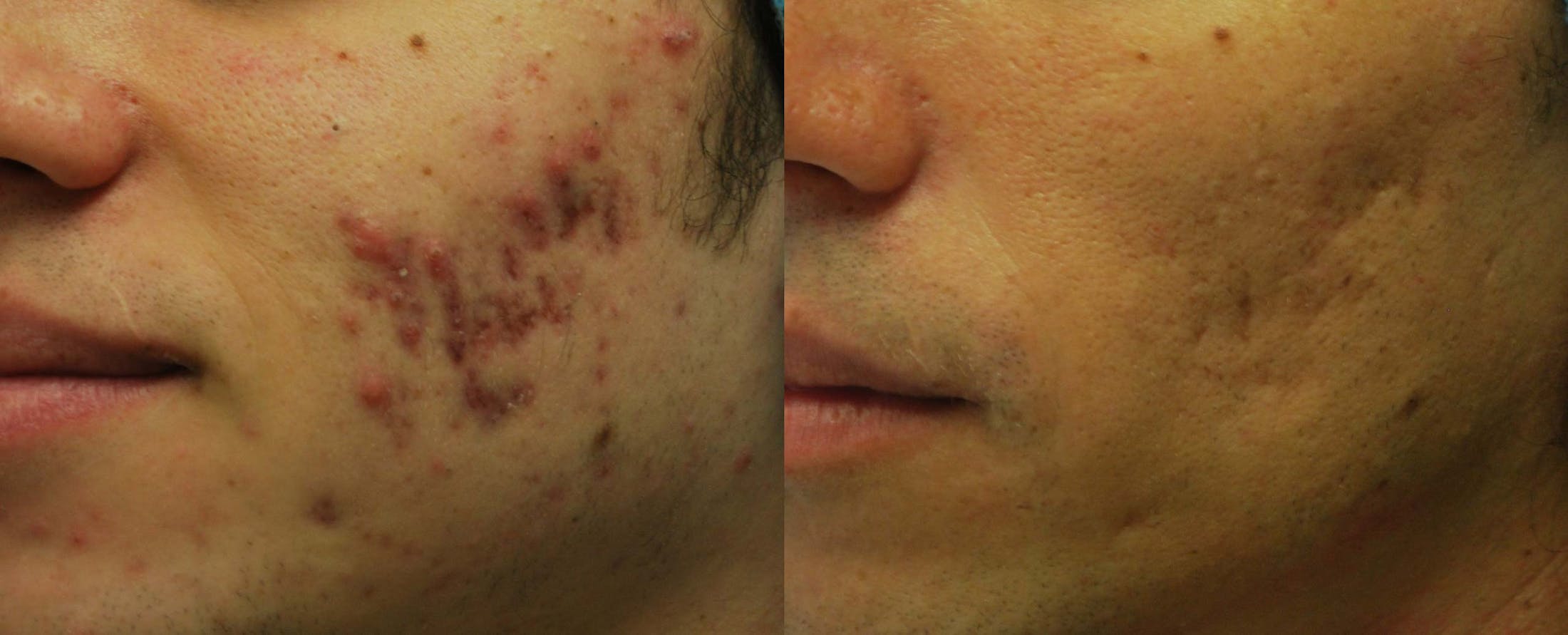 Morpheus8 Before & After Gallery - Patient 161571738 - Image 1