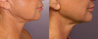 Morpheus8 Before & After Gallery - Patient 161571741 - Image 1