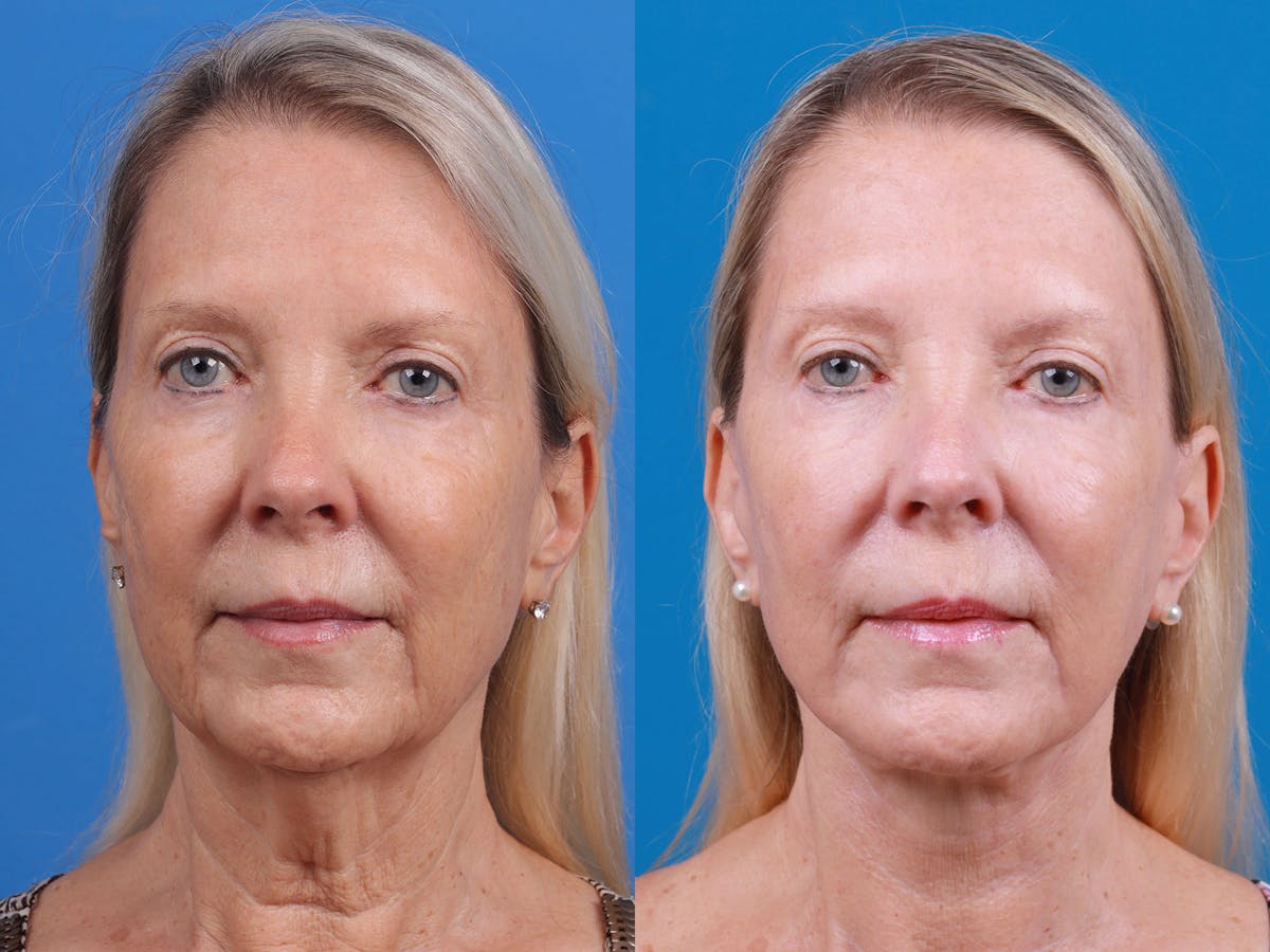 Facelift Before & After Gallery - Patient 163001391 - Image 1