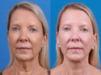 Facelift Before & After Gallery - Patient 163001391 - Image 1