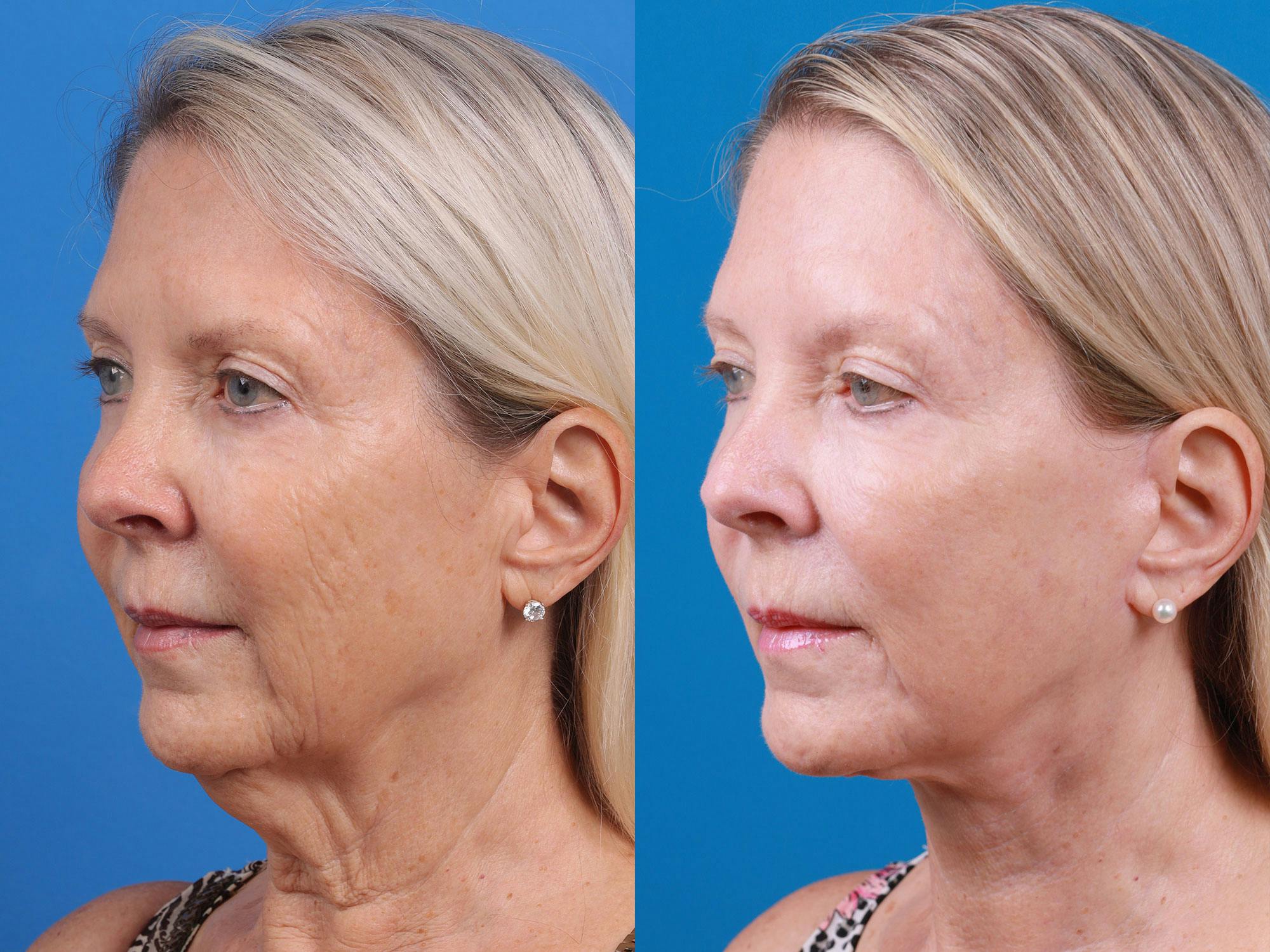 Facelift Before & After Gallery - Patient 163001391 - Image 2