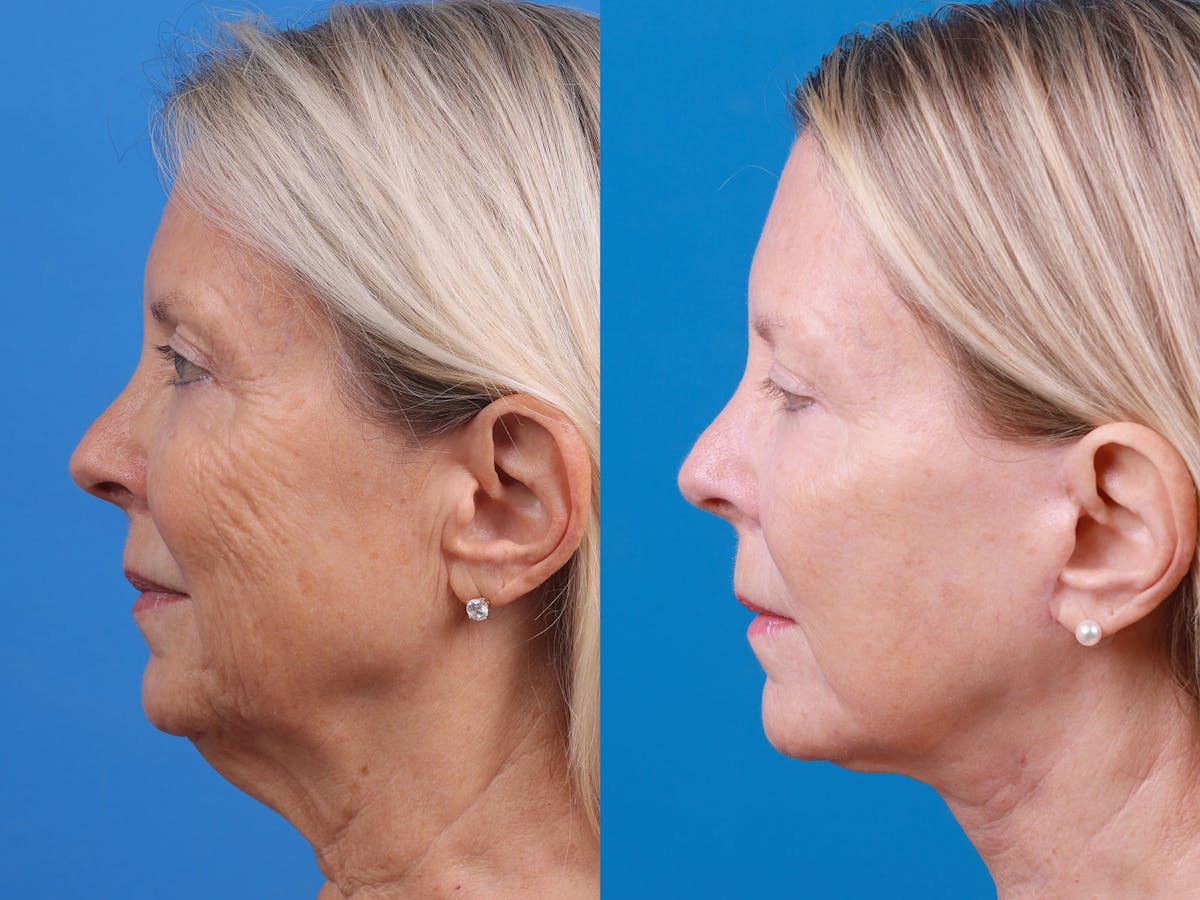 Facelift Before & After Gallery - Patient 163001391 - Image 3