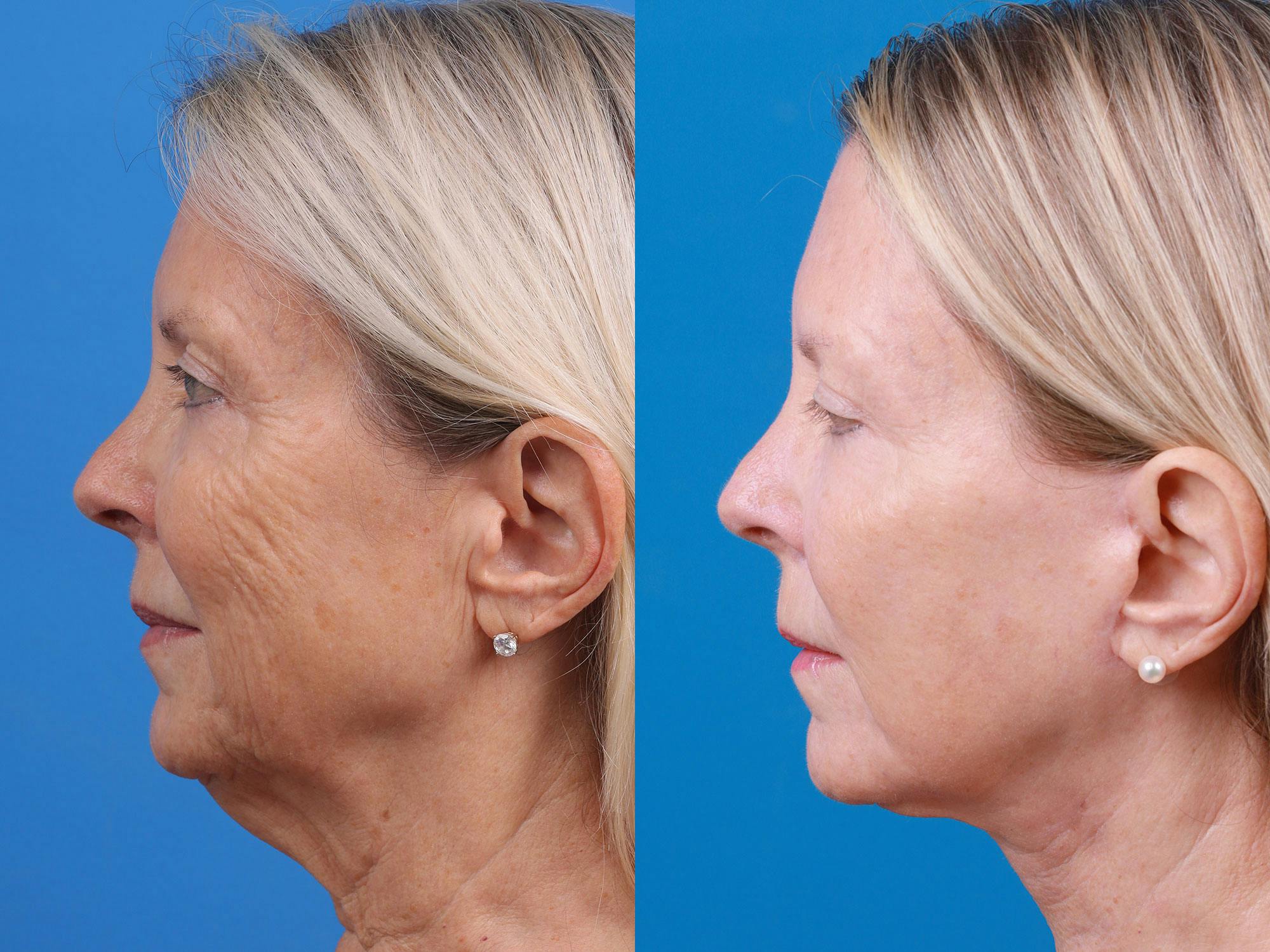 Facelift Before & After Gallery - Patient 163001391 - Image 3